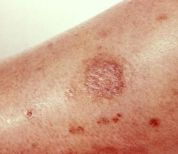 http://img.webmd.com/dtmcms/live/webmd/consumer_assets/site_images/articles/health_tools/bad_bugs_slideshow/cdc_photo_of_brown_recluse_spider_bite.jpg