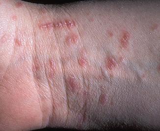 http://img.webmd.com/dtmcms/live/webmd/consumer_assets/site_images/articles/health_tools/bad_bugs_slideshow/dermnet_photo_of_scabies_inestation.jpg