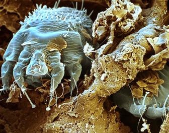 http://img.webmd.com/dtmcms/live/webmd/consumer_assets/site_images/articles/health_tools/bad_bugs_slideshow/PRinc_SEM_photo_of_scabies_mites_in_skin.jpg
