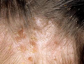 http://img.webmd.com/dtmcms/live/webmd/consumer_assets/site_images/articles/health_tools/bad_bugs_slideshow/dermnet_photo_of_head_lice_infestation.jpg