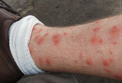http://img.webmd.com/dtmcms/live/webmd/consumer_assets/site_images/articles/health_tools/bad_bugs_slideshow/flickr_photo_of_chigger_bites_on_leg.jpg