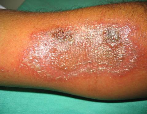 http://dermatology.cdlib.org/127/case_reports/paederus/2.jpg